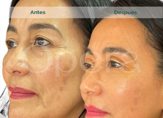 Caso-Blefaroplastia-4-párpados-antes-y-despues-ana-maria-monzon-05
