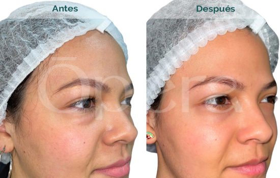 blefaroplastia-inferior-transconjuntival-mujer-joven-ana-maria-monzon-03a