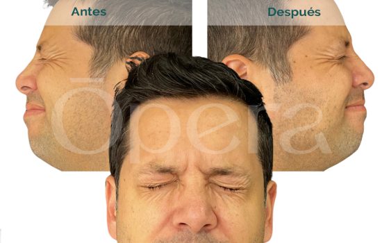 botox-hombre-antes-y-despues03